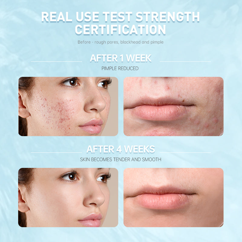 Achieve clear and bright skin with Auquest Acne Treatment Cream,